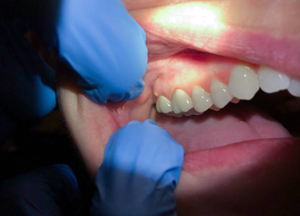 Best Emergency Broken Tooth Repair in Beverly Hills, CA